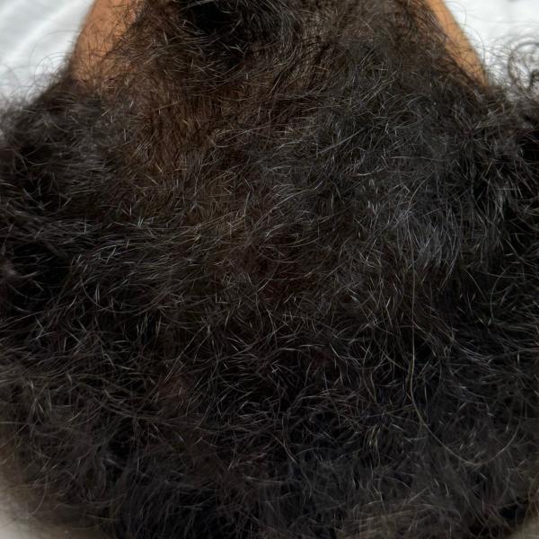 After: the same crown with dense hair covering the scalp.
