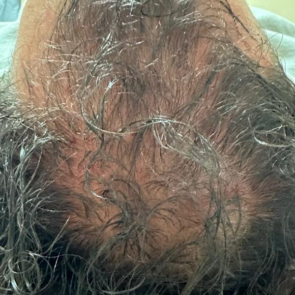 Before: scalp visible through thin hair across the whole crown.