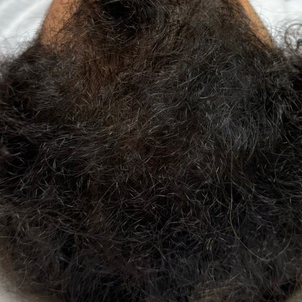 The same crown after the protocol: dense hair covering the scalp.