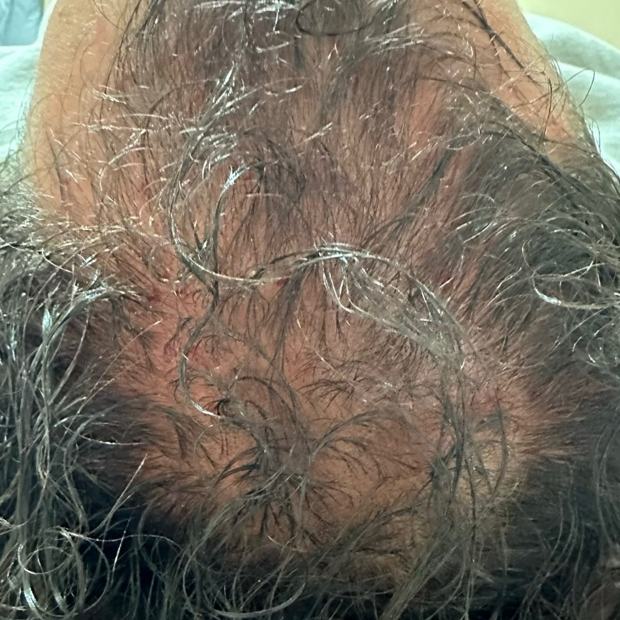 Crown before the protocol: scalp visible through thin hair across the whole crown.