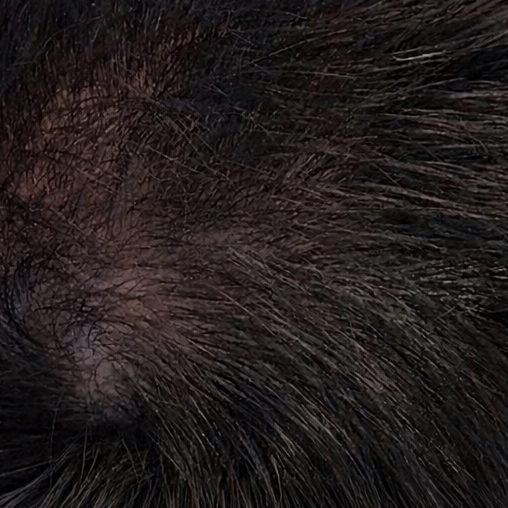 The same vertex after the protocol: the bare patch grown over with hair.