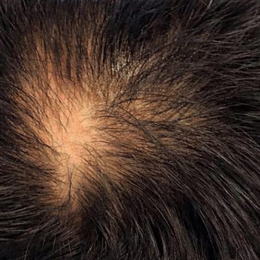 Vertex before the protocol: a bare patch of scalp at the whorl.