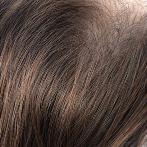 The same area after the protocol: dense hair with the scalp no longer visible.