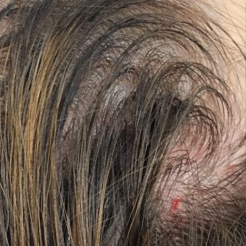 Diffuse thinning before the protocol: sparse hair with scalp visible through the part.