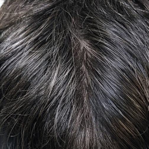 The same part line after the protocol: a narrower part with hair filled in on both sides.