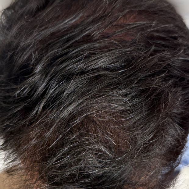 The same crown and temple after the protocol: fuller coverage, scalp no longer showing through.