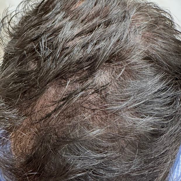 Crown and temple before the protocol: thin, see-through coverage with scalp showing.