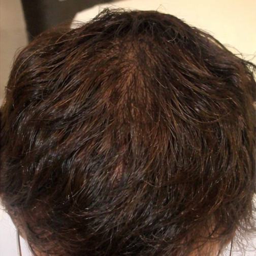 The same crown after the protocol: the bare area filled in with hair.